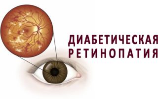 Диабетическая ретинопатия — хотите сохранить зрение, не тяните с лечением